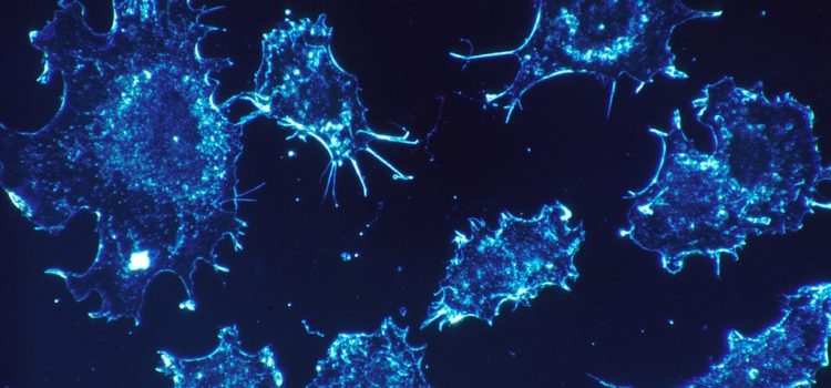 Génszerkesztéssel állították meg az egyik legagresszívebb mellrák sejtjeinek terjedését
